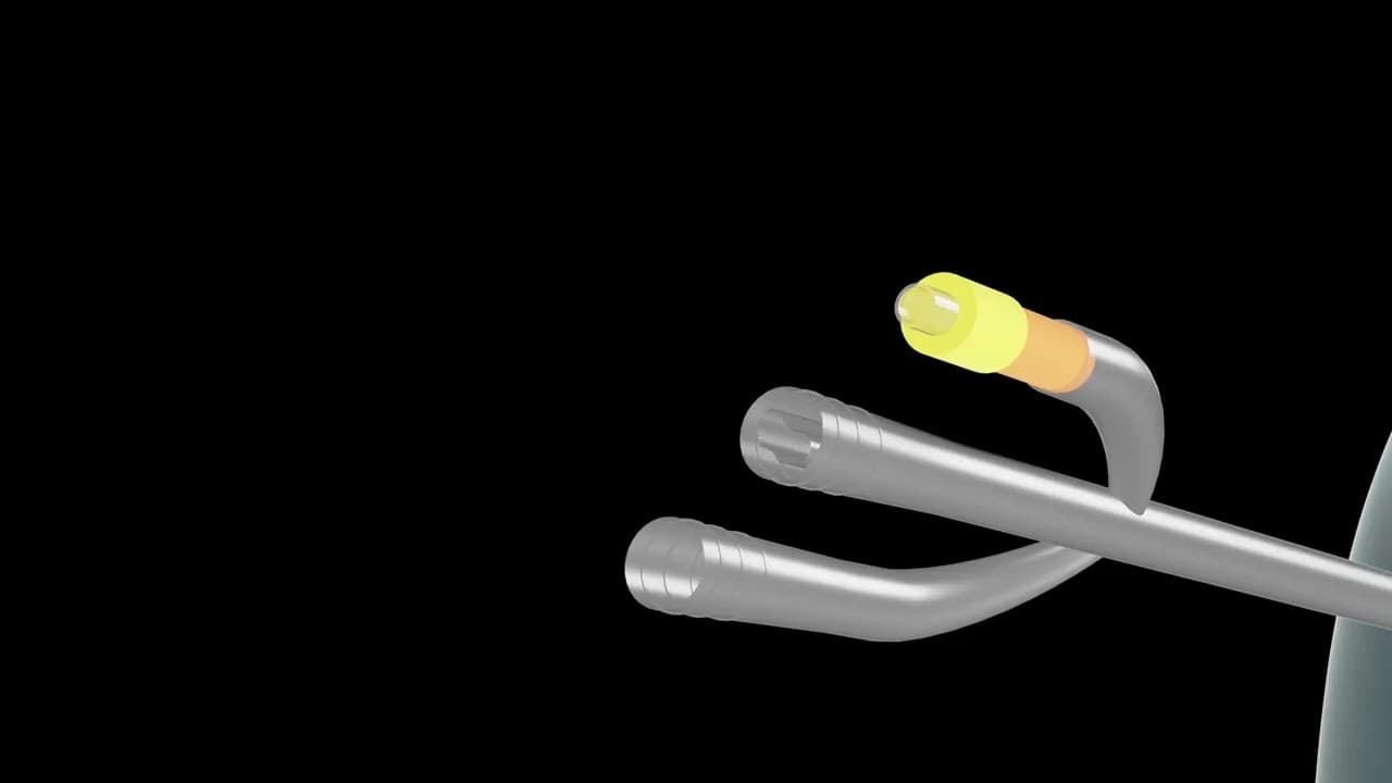  Urinary Catheter to stop bladder bleeding | 3D Medical Animation