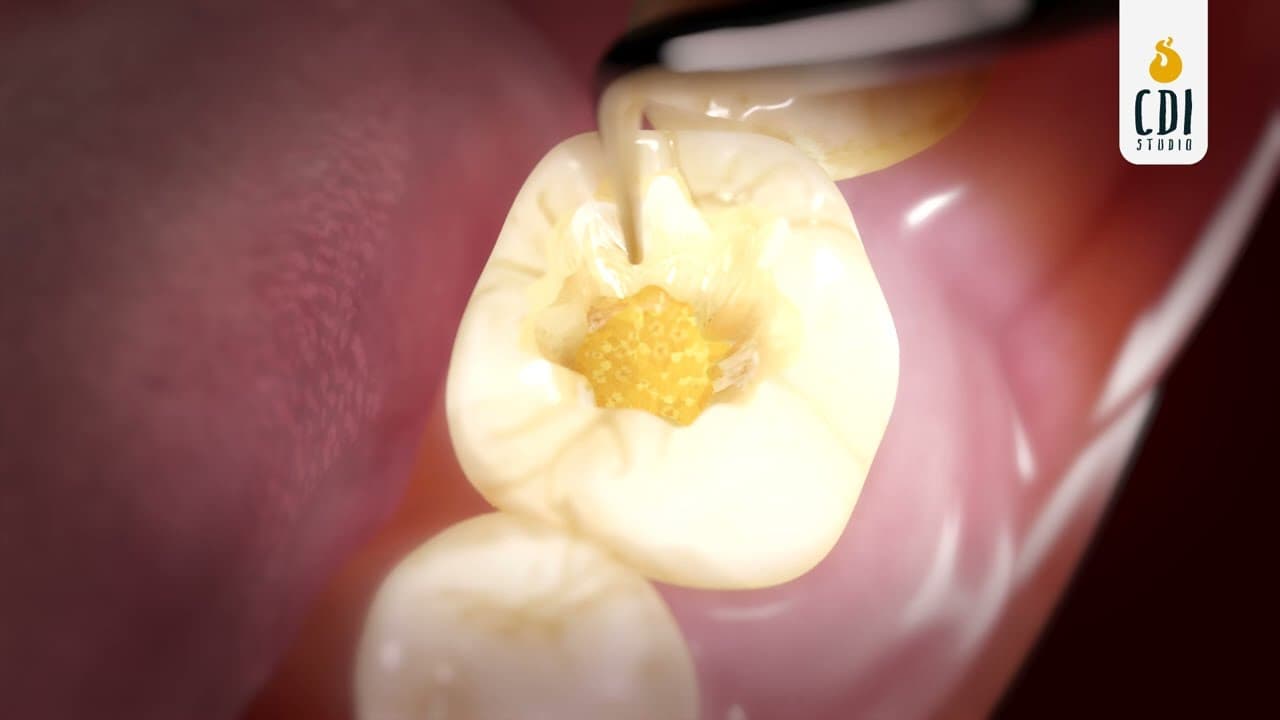 Root Canal Treatment | 3D Medical Animation